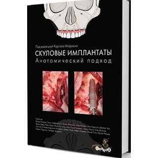 Скуловые имплантаты. Анатомический подход Карлос Апарисио 2017 г. (Дентал-Азбука)